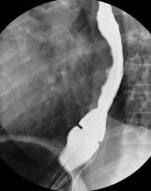 esophageal web barium swallow