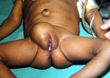 Large right inguinal hernia in 3-month-old girl. 