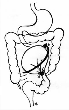 Sigmoid volvulus. (A) Counterclockwise torsion at 