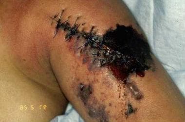 A patient developed gas gangrene after injecting c