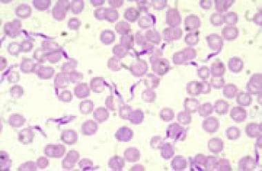 trypanosoma brucei symptoms