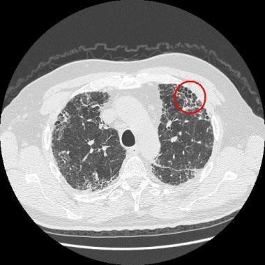 Classic subpleural honeycombing (red circle) in a 
