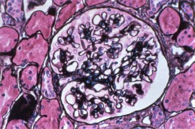 Membranous lupus nephritis showing thickened glome