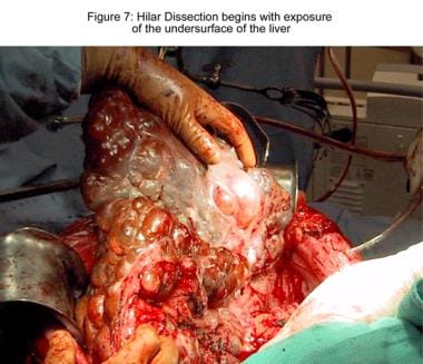 Liver transplantation. Hilar dissection begins wit