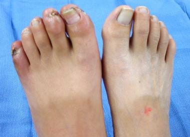 Feet of patient with thromboangiitis obliterans (B