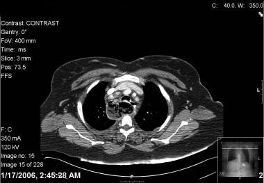 Chest CT of same patient showing gas-filled medias