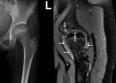 Juvenile idiopathic arthritis. Anteroposterior rad