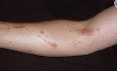 Forearm approximately 10 days after exposure to po