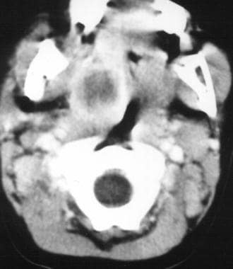 CT scan of the neck demonstrating left peritonsill