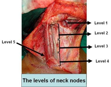 Levels of neck nodes. 