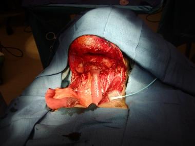 This photo shows the completion of the pedicle ana