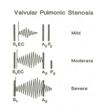 Valvar Pulmonary Stenosis. In valvar pulmonic sten