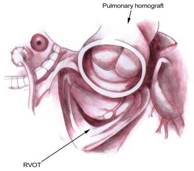 Placement of the pulmonary homograft into the pulm