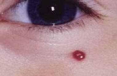 Small pyogenic granuloma. 