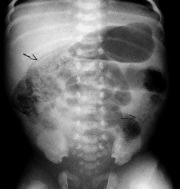 Pediatric Small Bowel Obstruction. The plain abdom