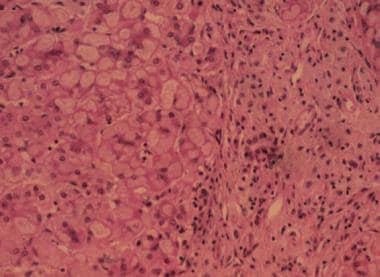 Liver section from a patient with glycogen-storage