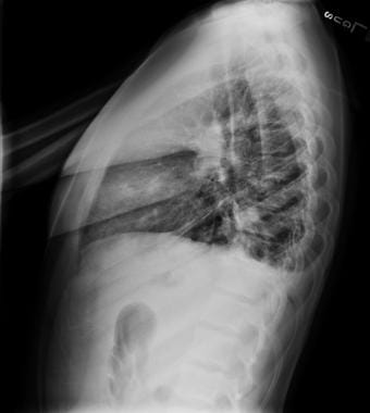 Lateral chest radiograph of a 15-year-old with sta