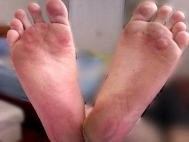 Friction blisters on human foot. Courtesy of Andry