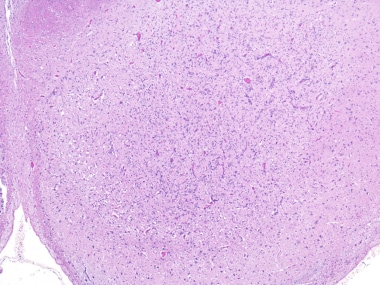 Early Wernicke encephalopathy. Note the prominent 