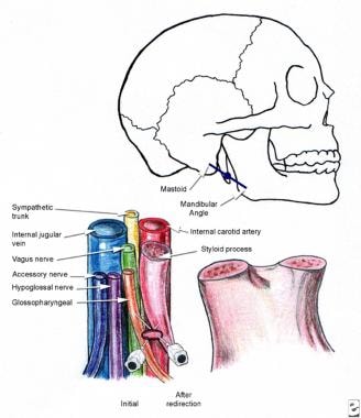 Glossopharyngeal block, peristyloid technique. 