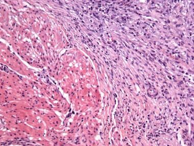 Postoperative spindle cell nodule of the bladder, 