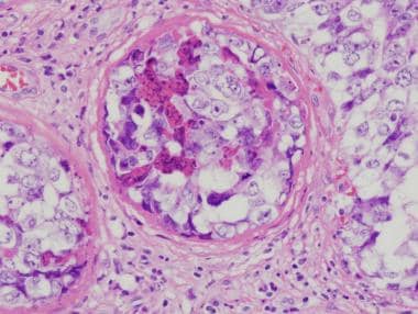 Pathology of embryonal carcinoma. Intratubular emb