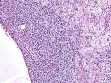 Higher magnification of the granulosa cell tumor s