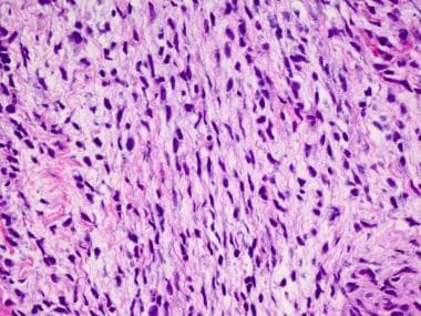 The sarcomatous component of a carcinosarcoma of t