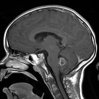 T1-weighted postcontrast sagittal magnetic resonan