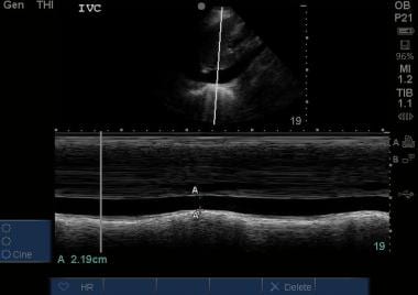 M-mode of an inferior vena cave (IVC) measured 2 c