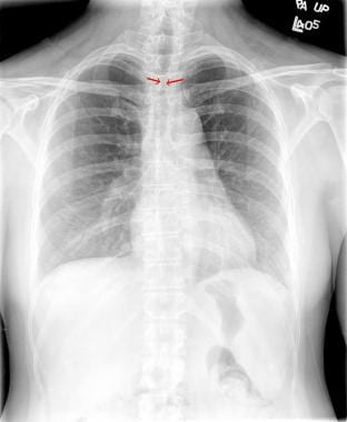 Chest radiography of female patient with tracheal 