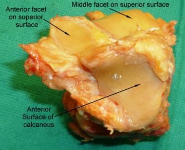 Anterior surface of the calcaneus bone. 