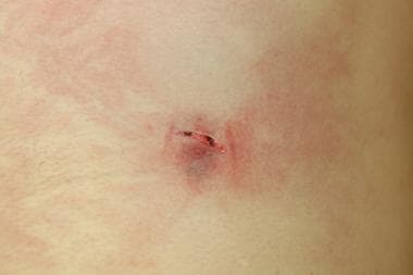 A slitlike, low-velocity exit wound. 