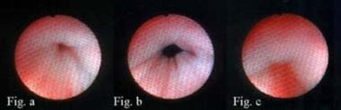 This shows classic type-II stress urinary incontin