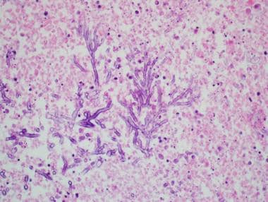 Invasive Aspergillosis: Septate hyphae with acute 