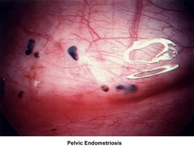Infertility. Pelvic endometriosis. Image courtesy 