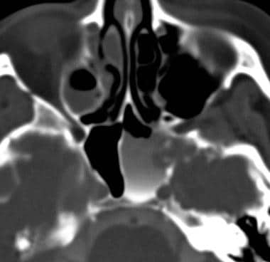 Axial CT image was obtained with the patient in th