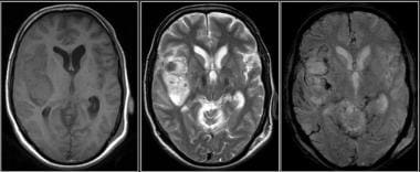 Magnetic resonance imaging. Large intracranial hemorrhage with moderate