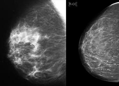 a, b Mammogram of 63-year-old woman. The LCC (left cranialcaudal