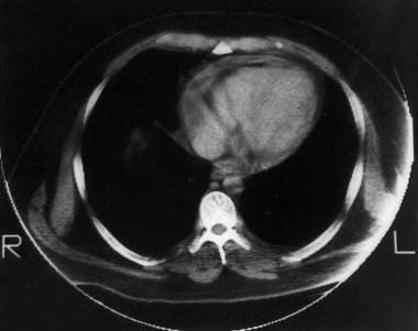 CT image obtained 8 years earlier of the heart in 
