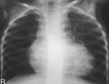 Plain frontal chest radiograph of a pseudotruncus.