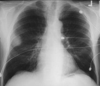 Solitary pulmonary nodule. Large well-circumscribe