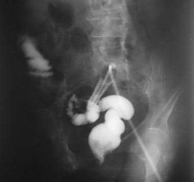 Single-contrast barium enema study demonstrates si