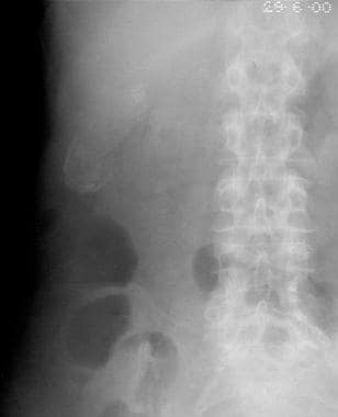 A plain abdominal radiograph that shows a right up