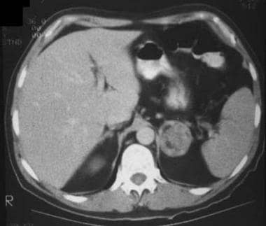 Contrast-enhanced CT in a 63-year-old man reveals 