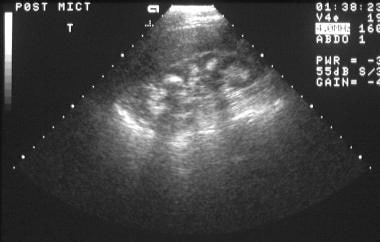 Sonogram of a kidney in a patient with medullary s