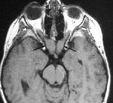 Axial noncontrast T1-weighted MRI reveals bilatera