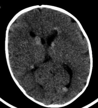 Axial nonenhanced CT scan obtained in the same pat