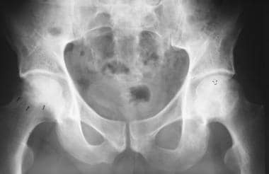 Anteroposterior view of the pelvis in a patient wi