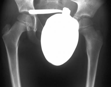 Radiograph of the hip in an 8-year-old child who p